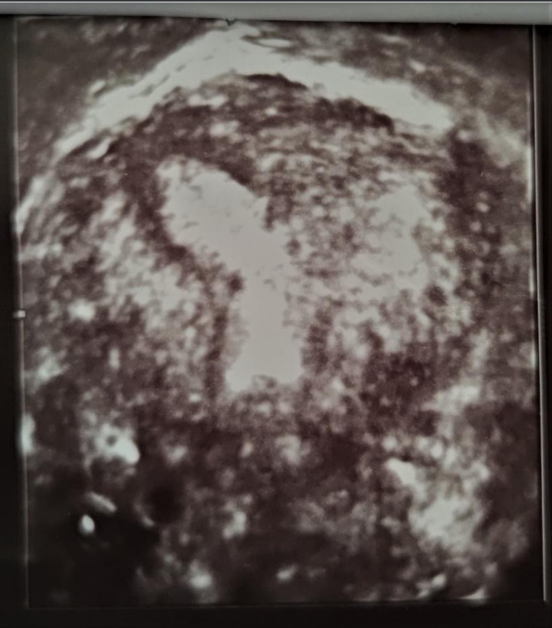 USG TV 3d w II fazie cyklu – widoczny prawidłowy prawy róg macicy oraz częściowo zarośnięty lewy róg i okolica dna macicy.